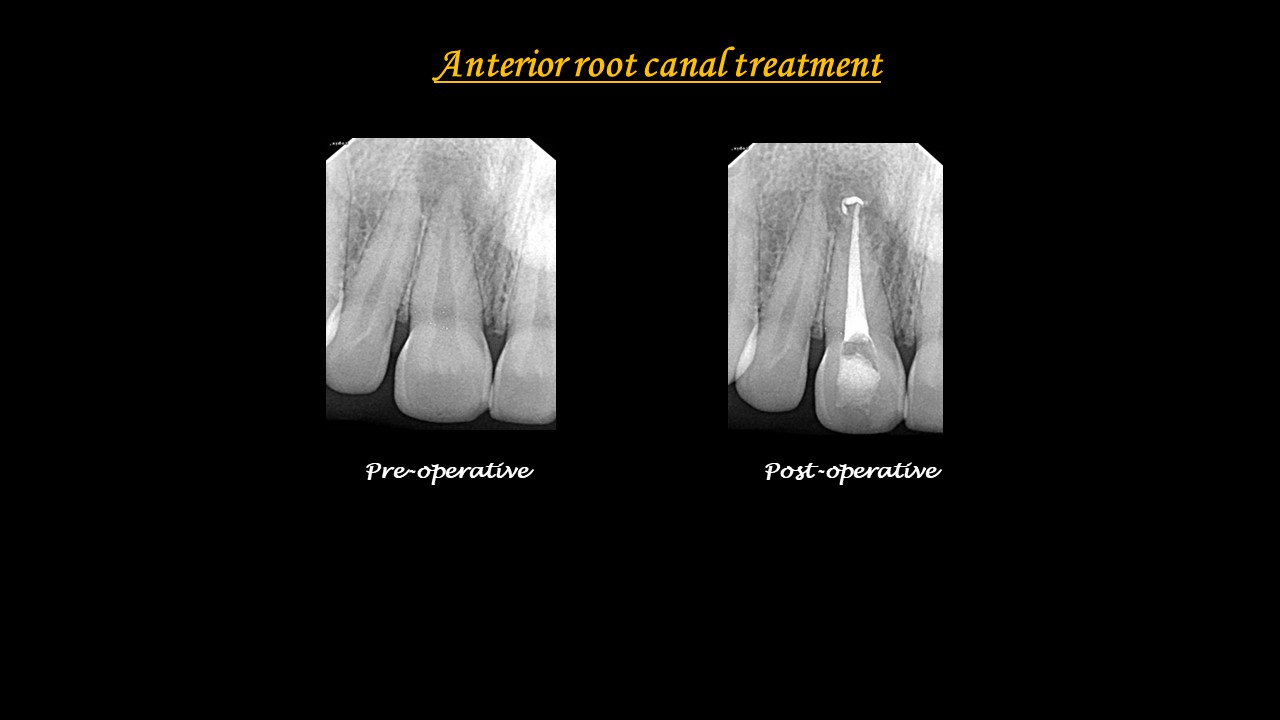 Root Canal Treatment