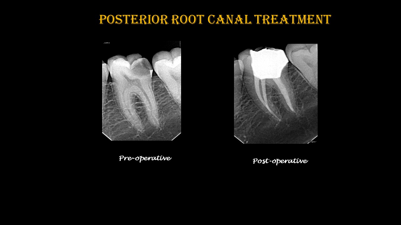 What is a Root Canal