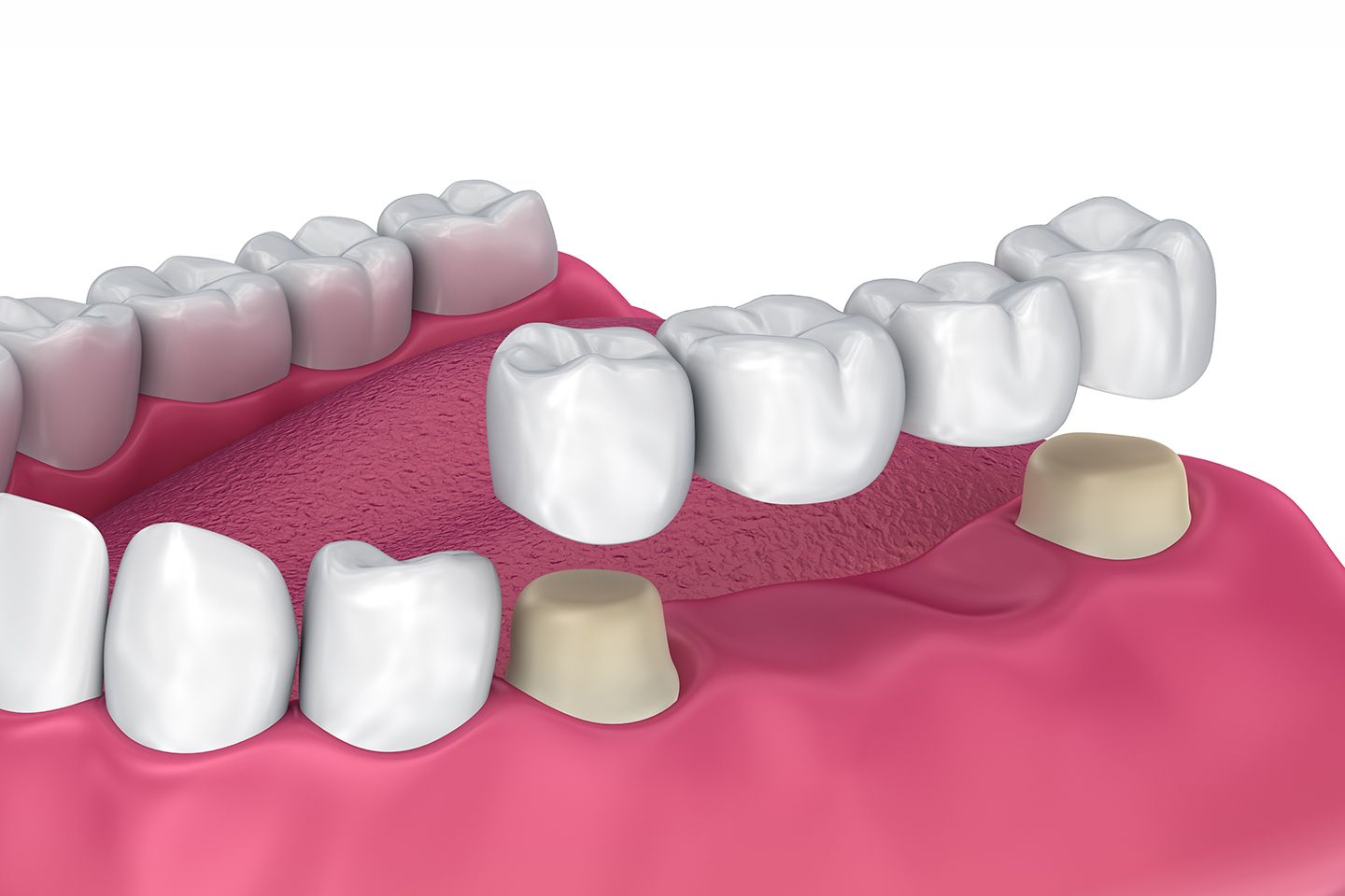 Smile Designing Using Teeth Braces Services in Hyderabad