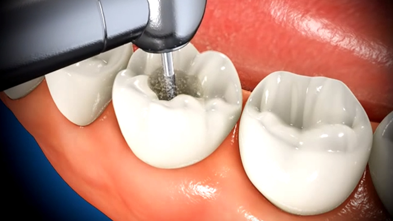 root-canal-treatment