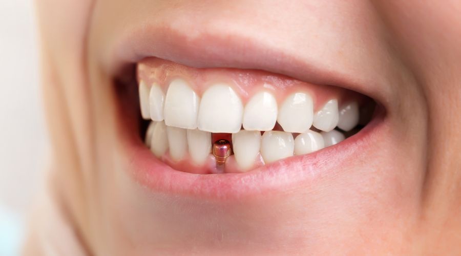 veneers-vs-dental-implants