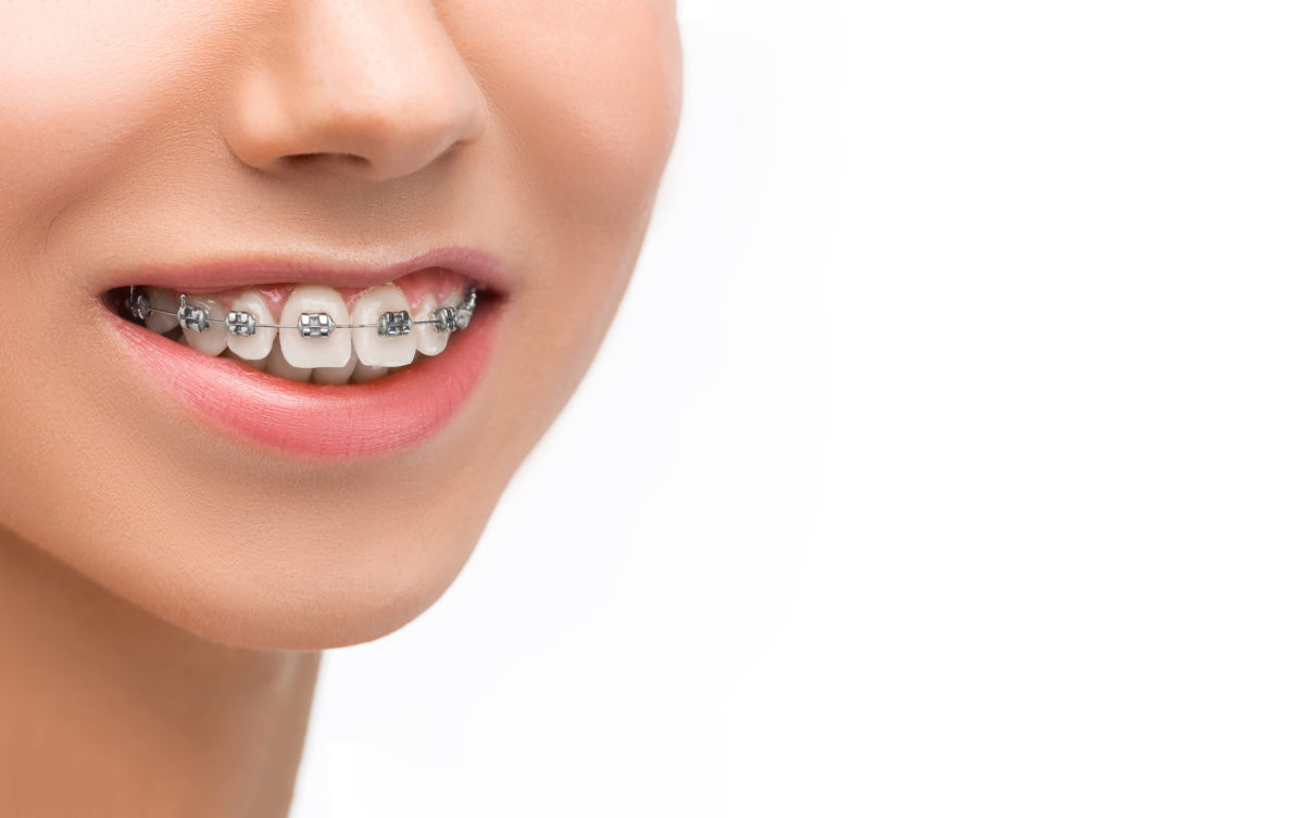 orthodontic-treatment-hyderabad