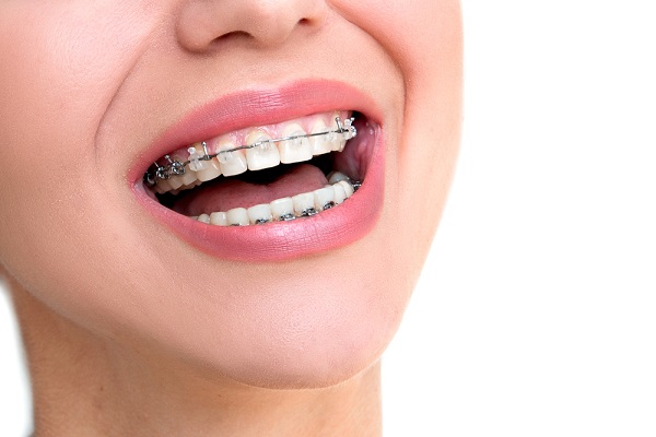 Get the Perfect Smile You Deserve Teeth Braces Services in Hyderabad