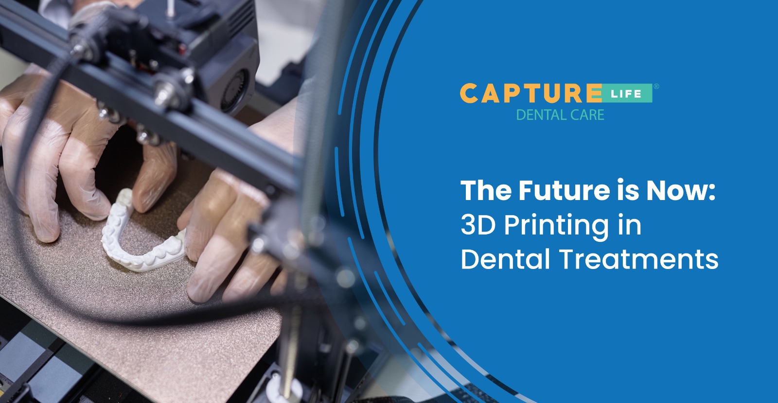 The Future is Now 3D Printing in Dental Treatments